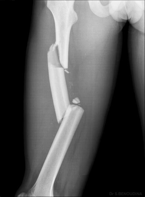 Right femur medial condyle (upper leg bone) fracture; ICD-10-CM S72. . Fracture right femur icd 10